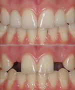 Missing Teeth in Greensboro and Summerfield NC....