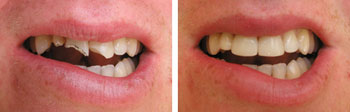 Back To School in Greensboro and Summerfield, NC? Don't Let This Happen To You - Protect Your Smile!