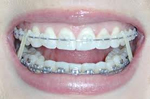 Clean teeth