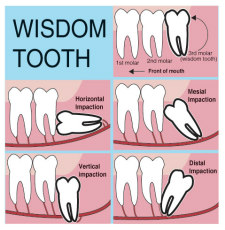Wisdom Teeth