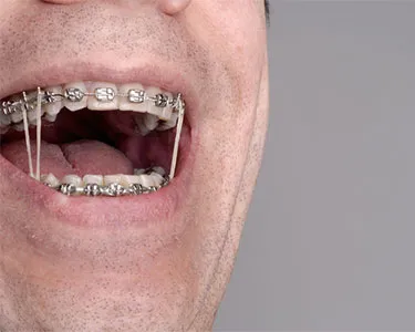Elastics for Braces, Explained.