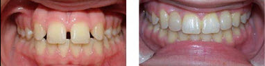 Don’t Rush Mother Nature When Moving Teeth…